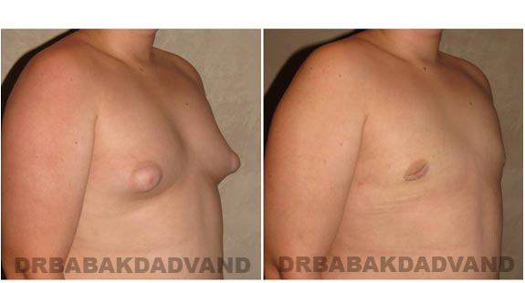 Breast-Gynecomastia: Before and After Photos. 16 year old man, right side, oblique view