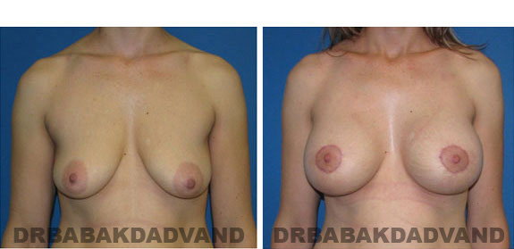 Before and After Photos. Breast-Breastlift: - 33 year old female, front view