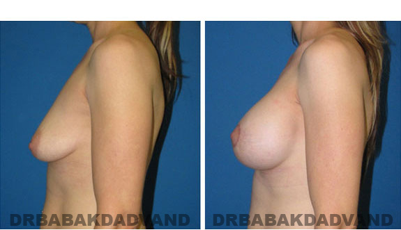 Before and After Photos. Breast-Breastlift: - 33 year old female, right side view