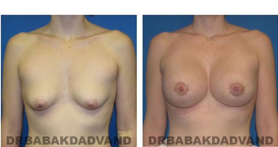 Before and After Photos. Breast-Breastlift: - 22 year old female, front view