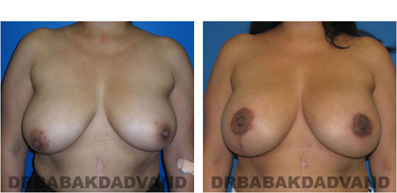 Before and After Photos. Breast-Breastlift: - 43 year old female, front view