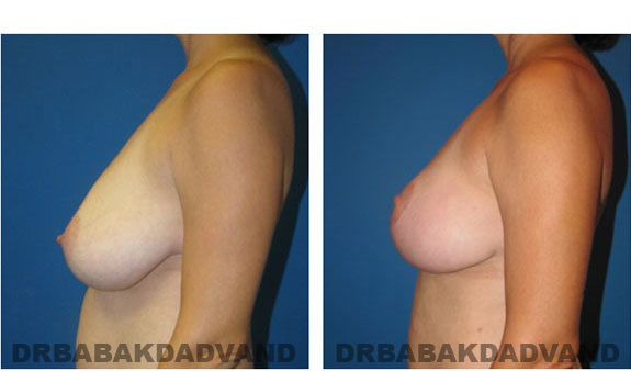 Before and After Photos. Breast-Breastlift: - 42 year old female, left side view