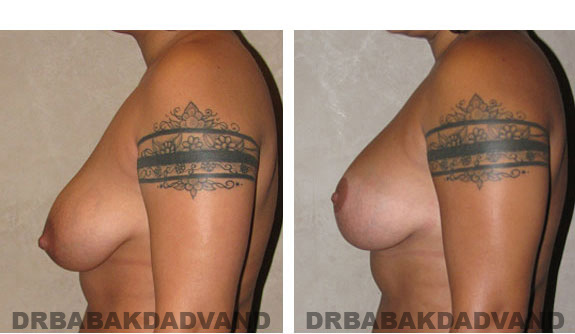 Before and After Photos. Breast-Breastlift: - 26 year old female, left side view