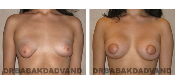Before and After Photos. Breast-Breastlift: - 20 year old female, front view
