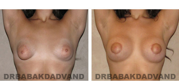 Before and After Photos. Breast-Breastlift: - 20 year old female, front view (hands up)