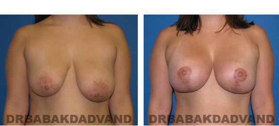 Before and After Photos. Breast-Breastlift: - 28 year old female, front view