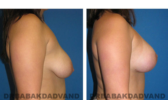 Before and After Photos. Breast-Breastlift: - 28 year old female, right side view