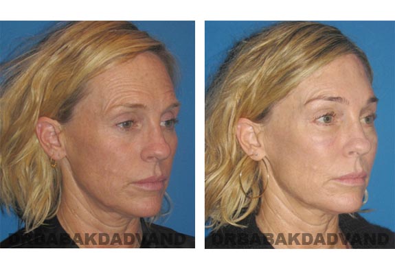 Before - After Photos |Browlift| 50 year old female, - right side,oblique view