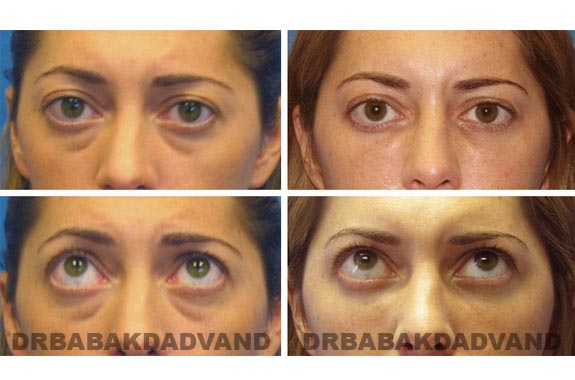 Before - After Photos |Eyelid| 34 year old female, - front view