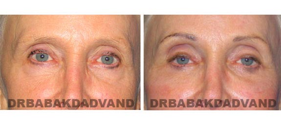 Before - After Photos |Eyelid| 67 year old female, - front view