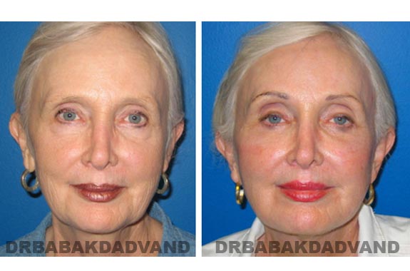 Before - After Photos |Facelift| 67 year old female, - front view