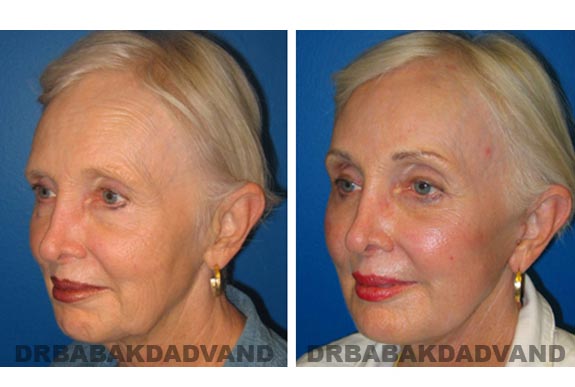 Before - After Photos |Facelift| 67 year old female, - left side,oblique view
