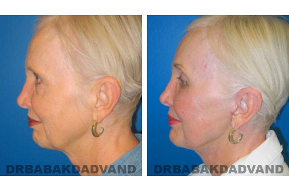 Before - After Photos |Facelift| 67 year old female, - left side