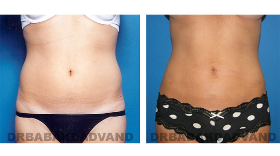 Before and After Photos |Liposuction| 32 year old woman, - front view