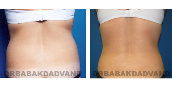 Before and After Photos |Liposuction| 32 year old woman, - back view