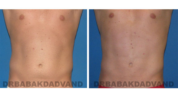 Before and After Photos |Liposuction| 29 year old male, - front view