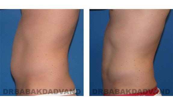 Before and After Photos |Liposuction| 29 year old male, - left side view