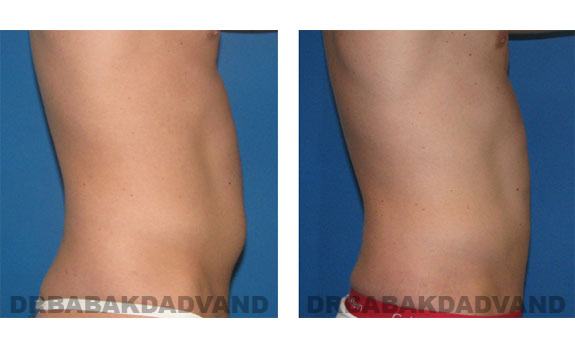 Before and After Photos |Liposuction| 29 year old male, - right side view