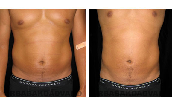 Before and After Photos |Liposuction| 32 year old male, - front view