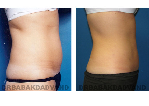 Before and After Photos |Liposuction| 32 year old female, - right side view