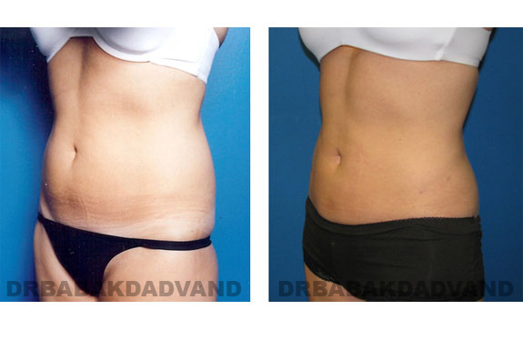 Before and After Photos |Liposuction| 32 year old female, - left side, oblique view