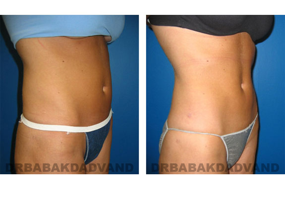 Before and After Photos |Liposuction| 32 year old woman, - right side, oblique view