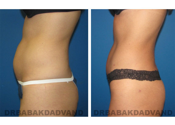 Before and After Photos |Liposuction| 33 year old woman, - left side view