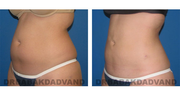 Before and After Photos |Liposuction| 28 year old woman, - left side, oblique view