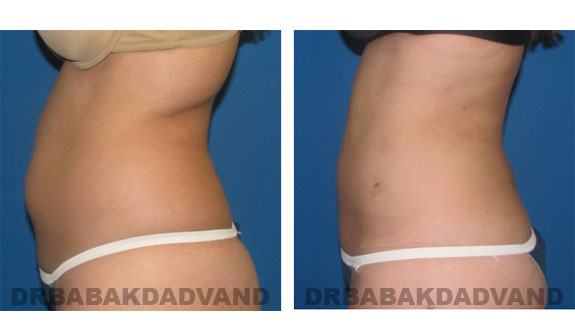 Before and After Photos |Liposuction| 28 year old woman, - left side view