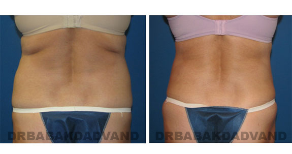 Before and After Photos |Liposuction| 43 year old woman, - back view