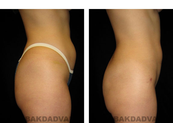 Before and After Photos |Liposuction| 33 year old woman, - right side view
