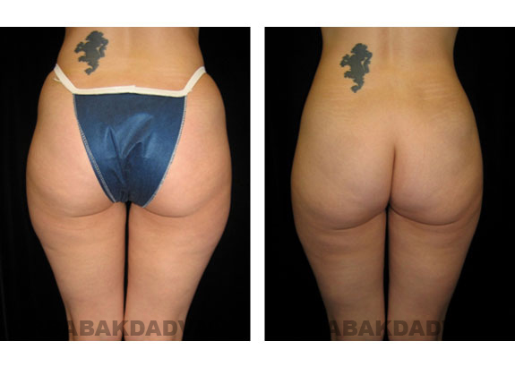 Before and After Photos |Liposuction| 33 year old woman, - back view