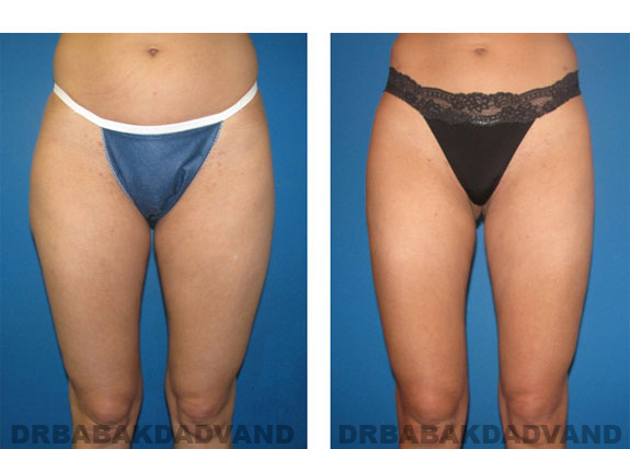 Before & After Photos |Liposuction| 32 year old woman, - front view