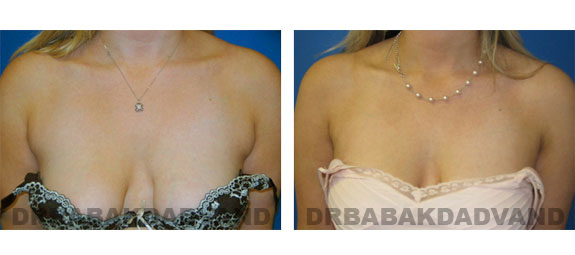 Before & After Photos |Liposuction| 26 year old woman, - front view (decollete)