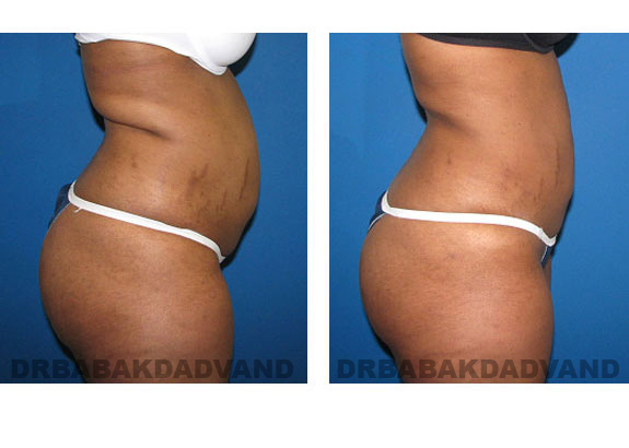 Before - After Photos |Liposuction| 32 year old woman, - right side view