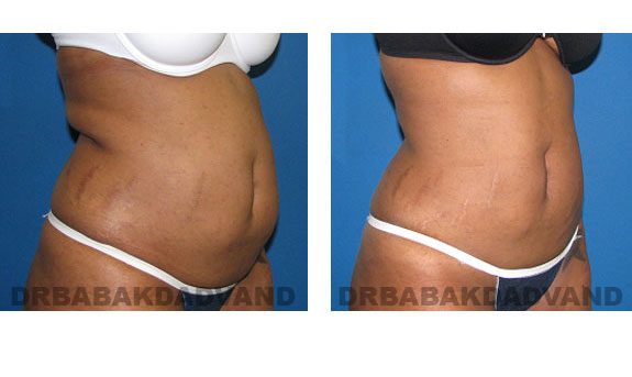 Before - After Photos |Liposuction| 32 year old woman, - right side, oblique view
