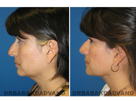 Before - After Photos |Necklift| 39 year old woman, - left side view