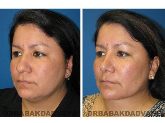 Before - After Photos |Necklift| 42 year old female, - left side,oblique view