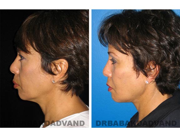 Before - After Photos |Necklift| 55 year old female, - left side view