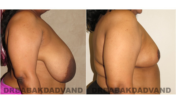 Before and After Photos. Breast-Reduction: - 54 year old female, right side view