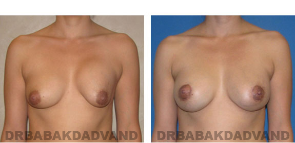 Before and After Photos |Revision Breast| - 36 year old female, - front view