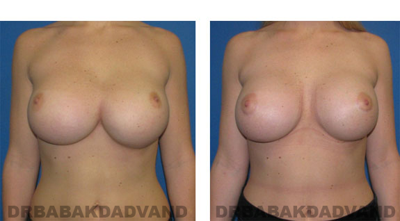 Before and After Photos |Revision Breast| - 23 year old female, - front view