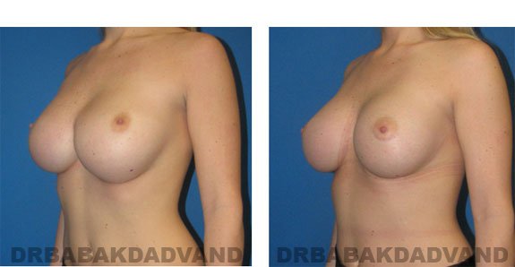 Before and After Photos |Revision Breast| - 23 year old female, - left side, oblique view