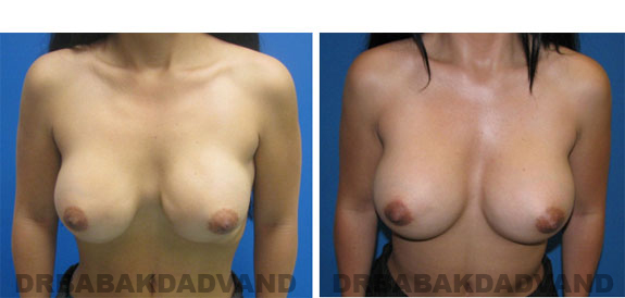 Before and After Photos |Revision Breast| - 37 year old female, - front view (inclined forward)