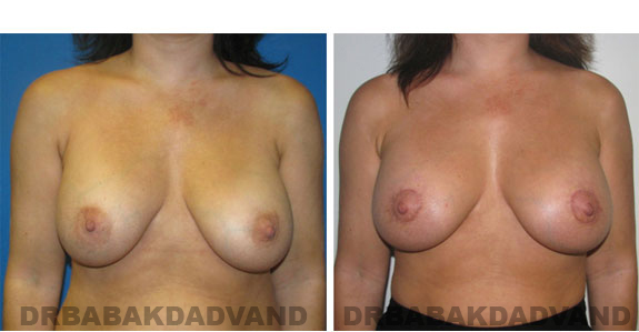 Before and After Photos |Revision Breast| 40 year old female, - front view