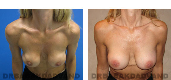 Before and After Photos |Revision Breast| - 46 year old female, - front view (inclined forward)