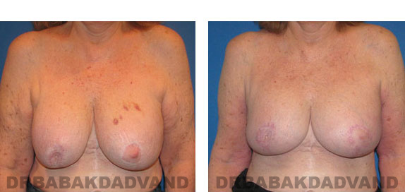 Before and After Photos |Revision Breast| 67 year old female, - front view