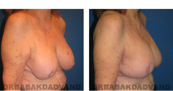 Before and After Photos |Revision Breast| 67 year old female, - right side, oblique view