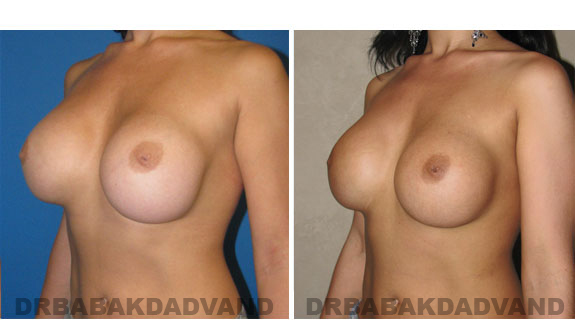 Before and After Photos |Revision Breast| 28 year old female, - left side, oblique view