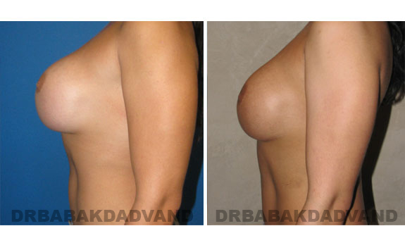 Before and After Photos |Revision Breast| 28 year old female, - left side view